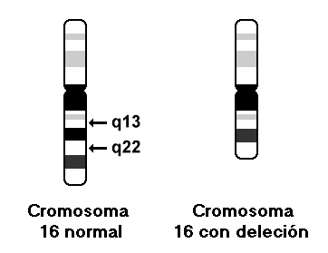 idiograma deleción 16